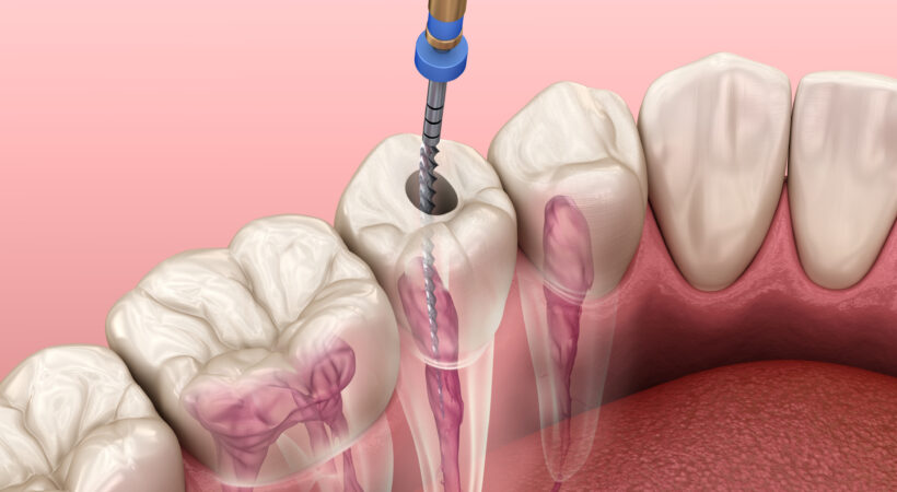 nanorobots in root canal treatment