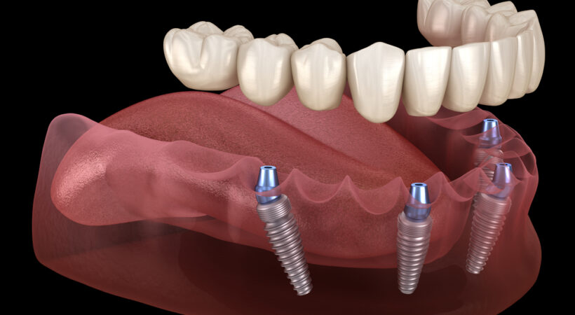 All on 4 dental implants