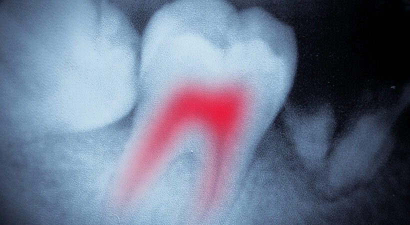 Root Canal